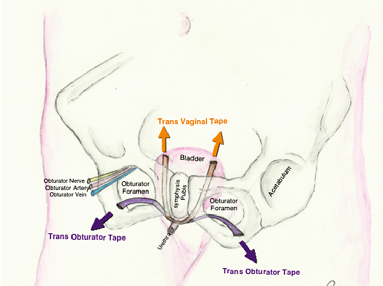 Urinary Incontinence In Women Part 2 Management Urology News Urinary Incontinence In Women Part 2 Management Urology News