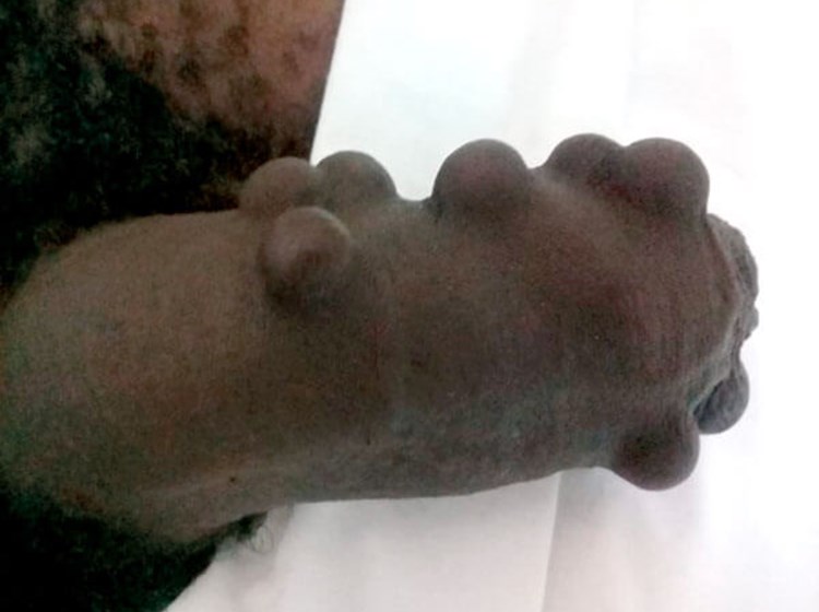 Artificial Penile Pearls What Every Urologist Should Know Urology News