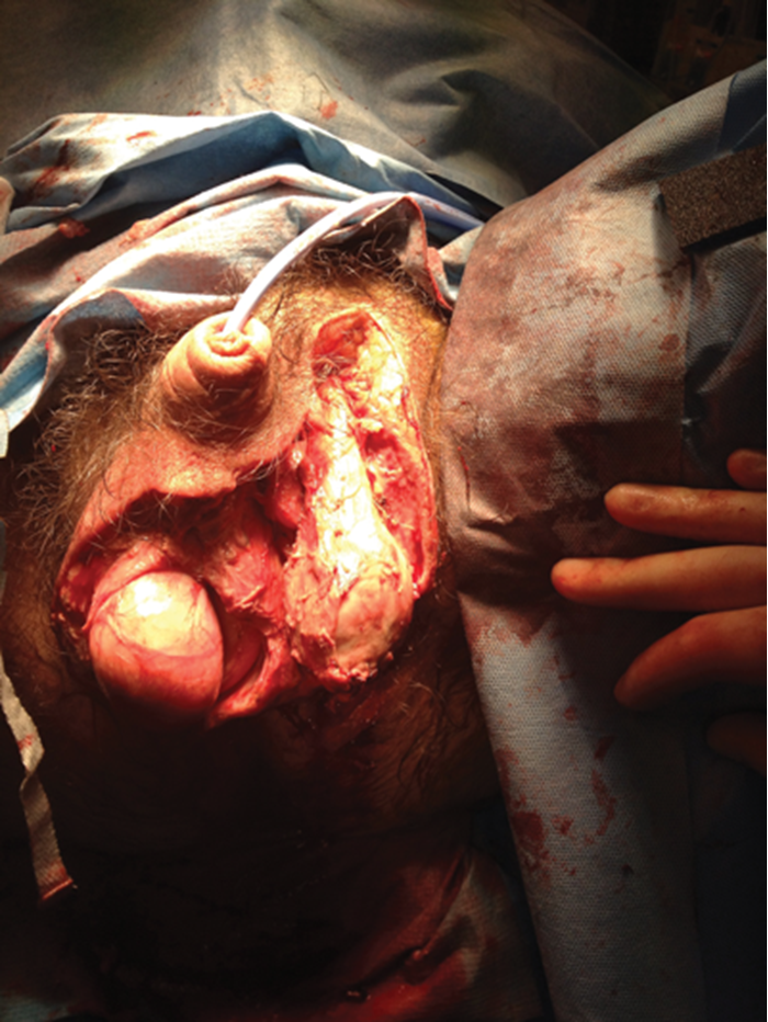 Fournier's gangrene | Urology News