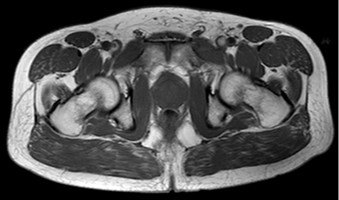 MULTIPARAMETRIC MR IMAGING OF PROSTATE TUMORS: PI-RADS V.2.1