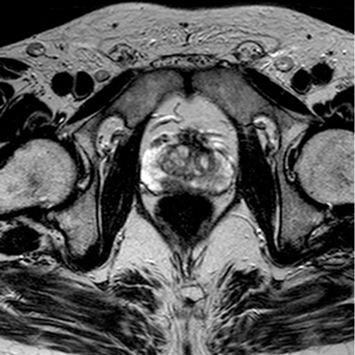 normal prostate mri Fájdalom a prosztatitis hátsó részén