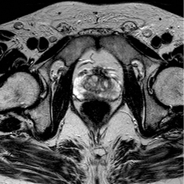 68Ga-PSMA PET/CT or PET/MRI in Evaluating Patients With Recurrent Prostate Cancer