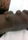 Image showing artificial pearls in the penis.