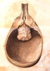 The obstructing prostate, from John Hunter’s book Venereal Disease illustration