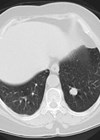 Bladder cancer image
