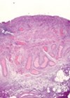 Urothelium demonstrating denudation of the GAG layer and infiltration with inflammatory cells image