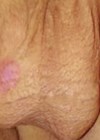 11-year-old boy with a 24-hour history of right sided scrotal pain and swelling photo