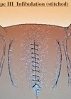 Illustration of Type 3 Infibulation (stitched). 