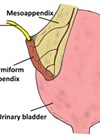 Illustration of bladder/appendix/catheter.