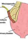 Illustration of bladder/appendix/catheter.