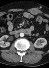 Axial CT image 12 months post surgery demonstrating a thickening of the left rectus muscle.
