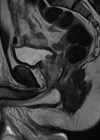 T2 weighted sagittal MRI of the prostate gland demonstrating the anterior tumour.