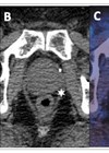 Images showing 68Ga-THP-PSMA PET-CT in staging of primary prostate cancer. A: PET image  B: Axial CT  C: Fused PET-CT image.