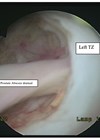 Scan showing transurethral deroofing of prostate abscess.