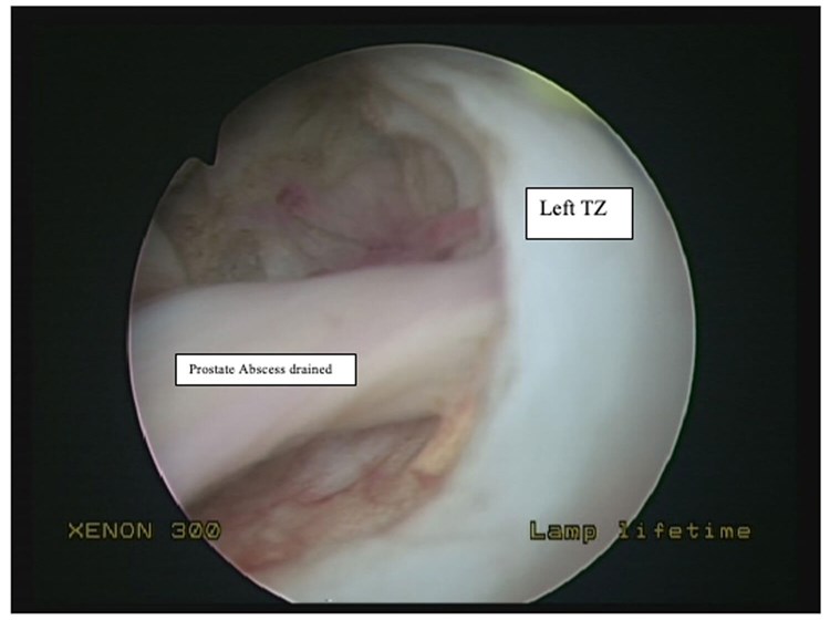 Prostatic Fluid Sample Procedures