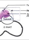 Histology slide from initial renal mass biopsy showing tumour deposits in the perinephric fat. 