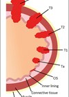 Illustration showing bladder cancer staging.