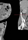 Reconstructed CT scan in urographic phase showing a large UTUC in the renal pelvis.