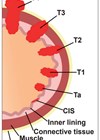 Illustration showing bladder cancer staging.