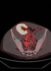 Scan showing renal transplant at the level of the iliac crest.