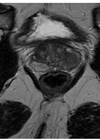 Pre prostate biopsy MRI pelvis. T2 sequence showing anatomy of the prostate.