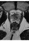 Pre prostate biopsy MRI pelvis. T2 sequence showing anatomy of the pubic symphysis. 