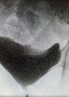 Video-urodynamic image taken when a patient was asked to cough.