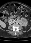 CT image showing 8cm tumour in the left moiety of a horseshoe kidney. 