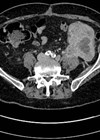 Image showing axial CT section demonstrating upper tract CCUC recurrence in left retroperitoneum.
