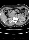 CT scan showing upper tract abnormality.