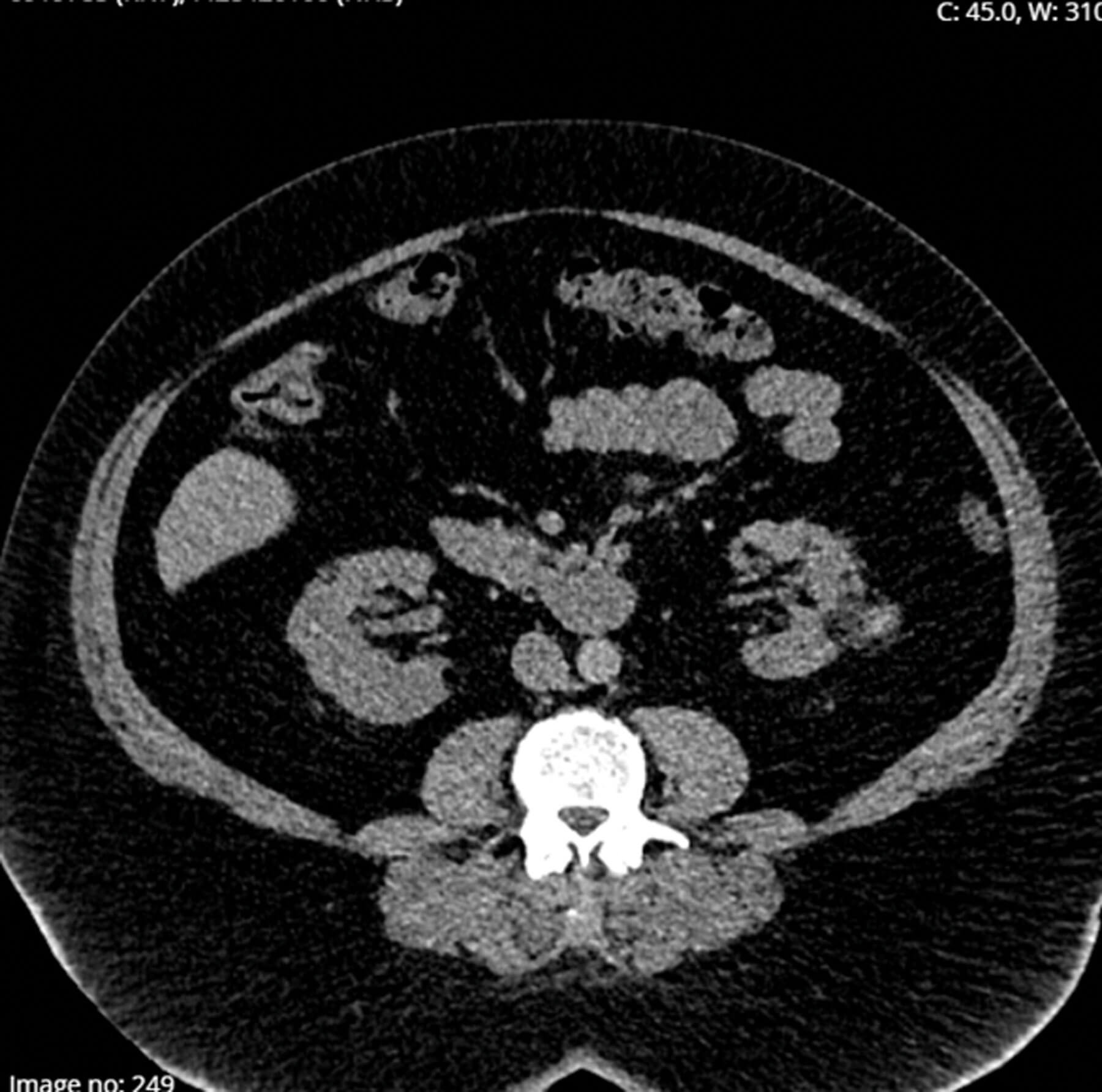 CT scan showing a left renal angiomyolipoma measuring 3cm.