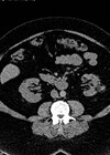 CT scan showing a left renal angiomyolipoma measuring 3cm.