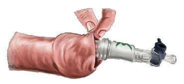 NOVOGLAN® Phimosis Treatment