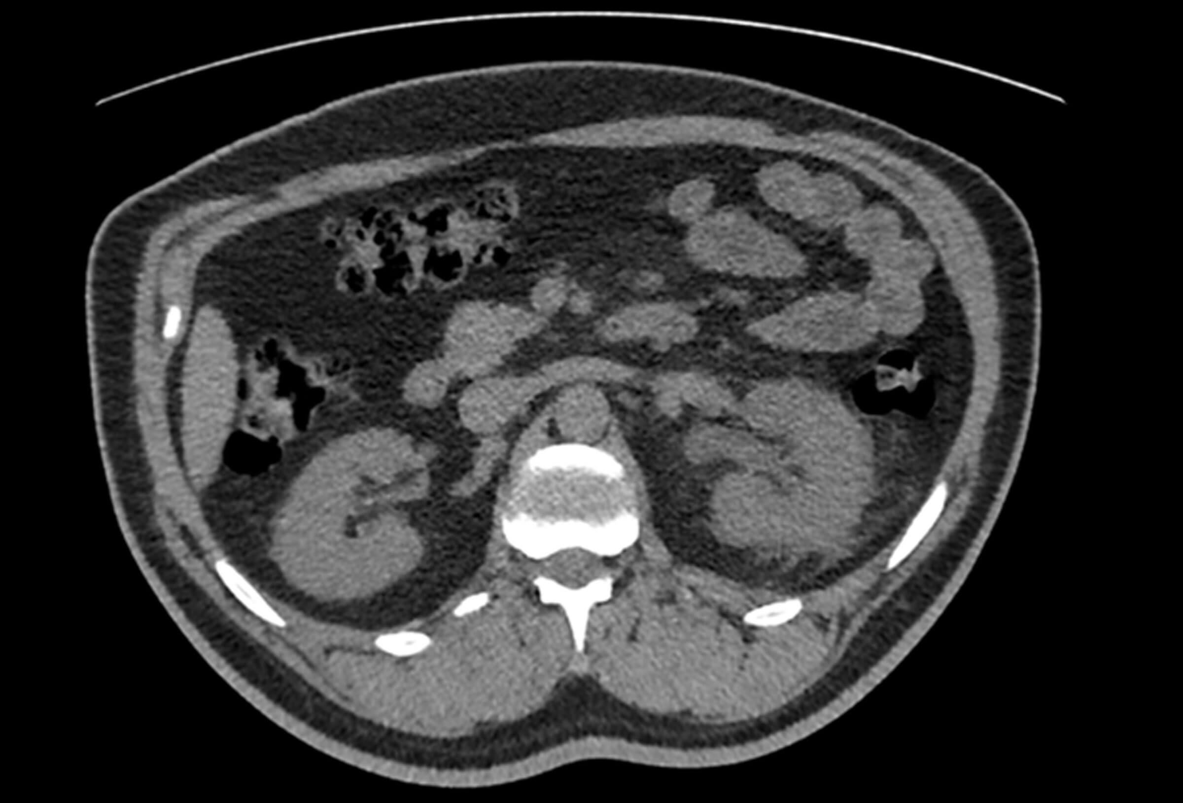 Scan image showing upper urinary tract obstruction.
