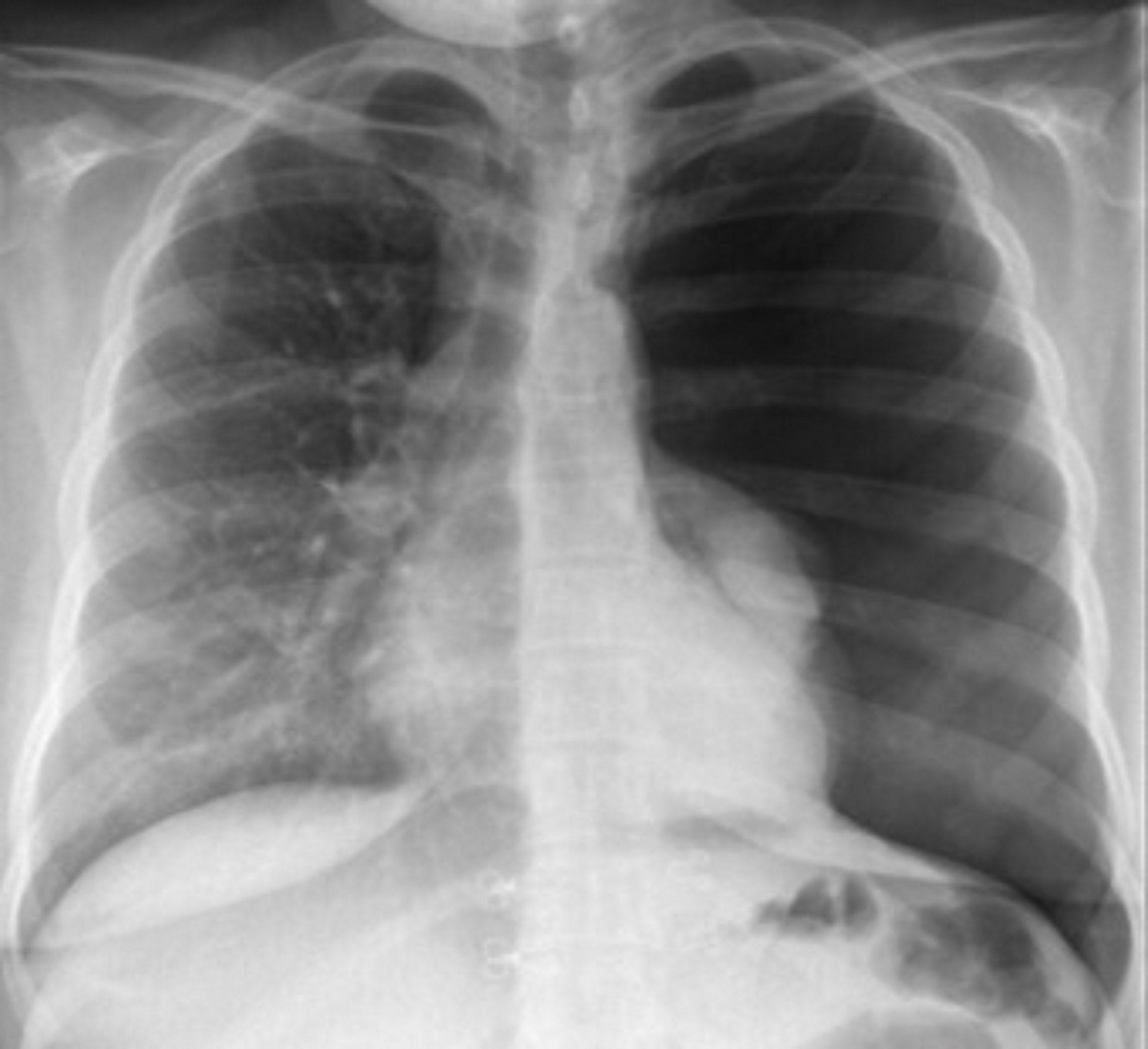 Image shows PA chest x-ray demonstrating absence of lung markings in the left hemithorax with a collapsed left lung around the left hilum and mild mediastinal shift to the right.
