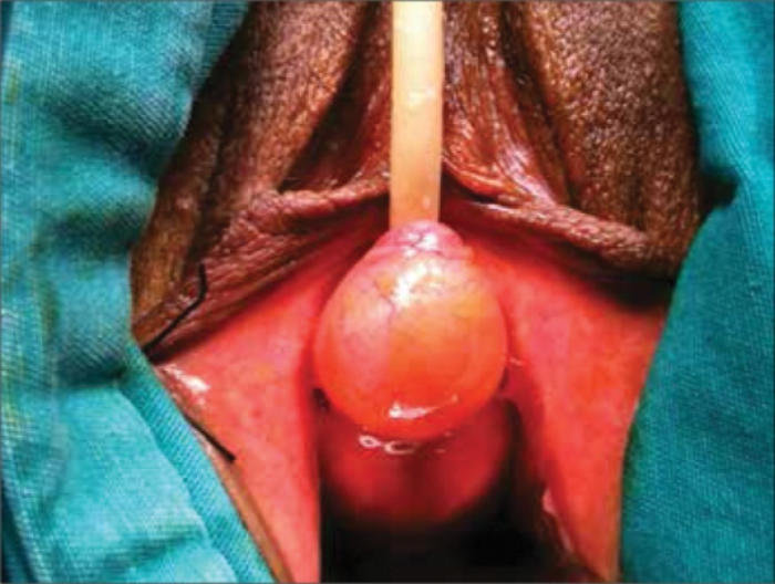 A review of the diagnosis and management of urethral caruncles