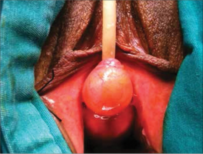 A Review Of The Diagnosis And Management Of Urethral Caruncles Urology News