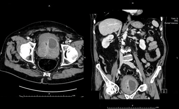 Status postneoplasm prostatic iradiat