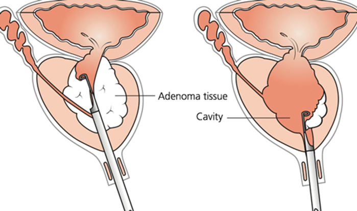TUR-P - tratamentul modern al adenomului de prostată - Medpark